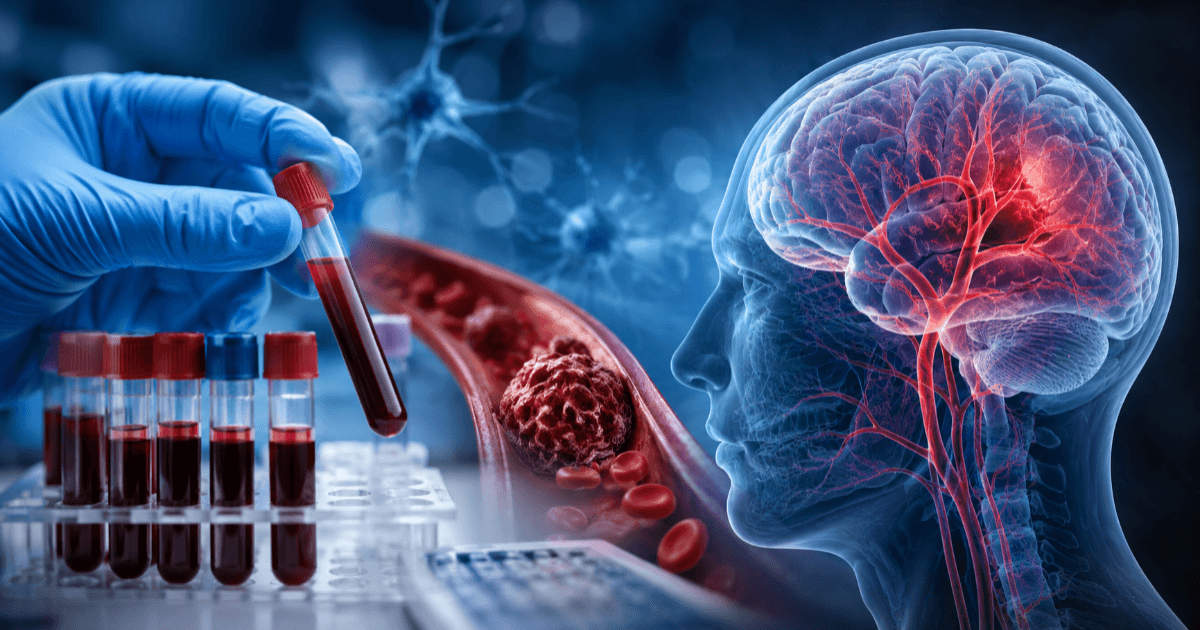 Do Blood Types Affect Stroke Risk? The Small but Significant Differences Observed in Type A and Type O