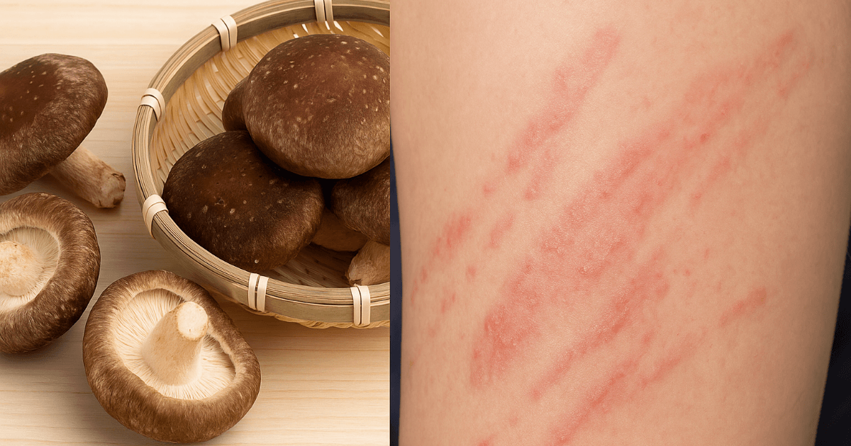 Even Edible Shiitake Mushrooms Require Caution! A Guide to Preventing "Shiitake Dermatitis" and Mushroom Food Poisoning