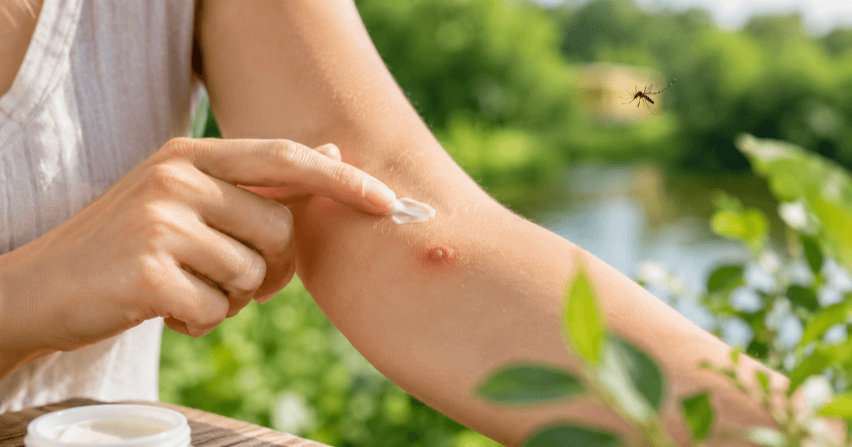 唾液から塗り薬まで ― 蚊に刺されたとき、本当に効く対処法とは